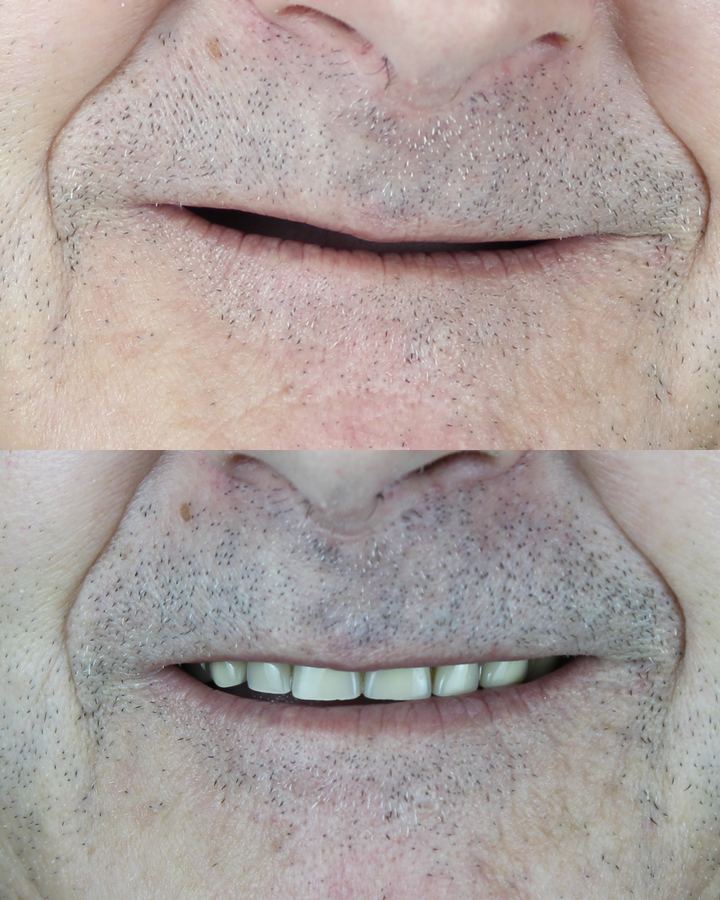 Antes e depois: Protocolo superior