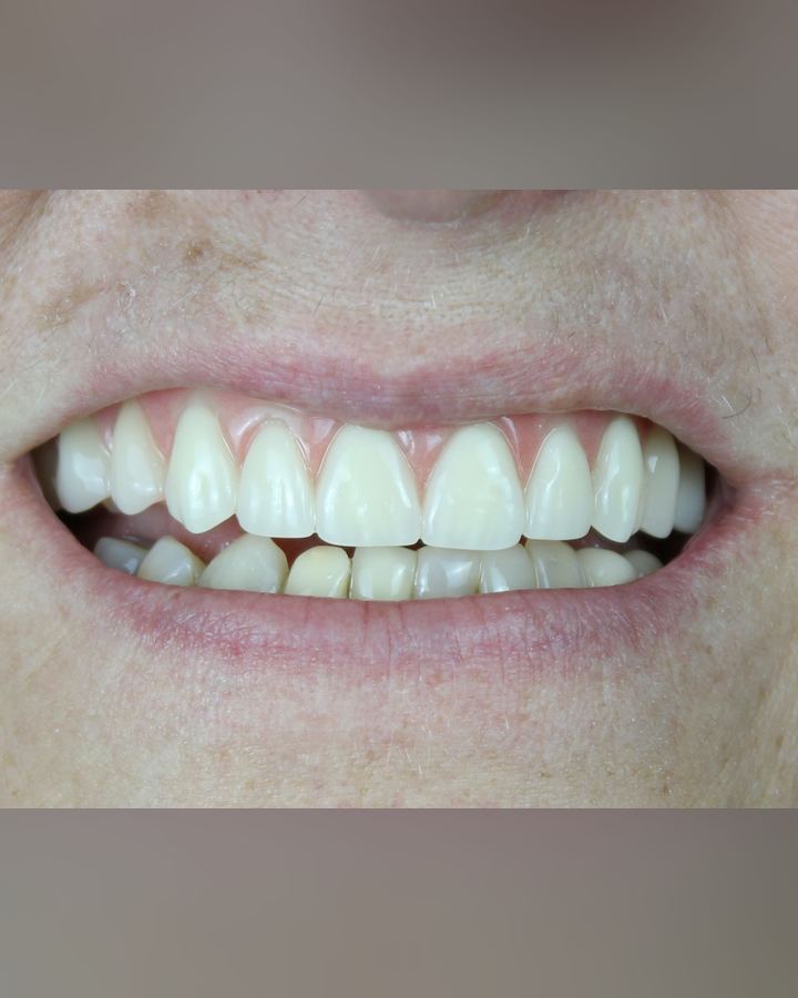 Resultado: Protocolo sobre implantes