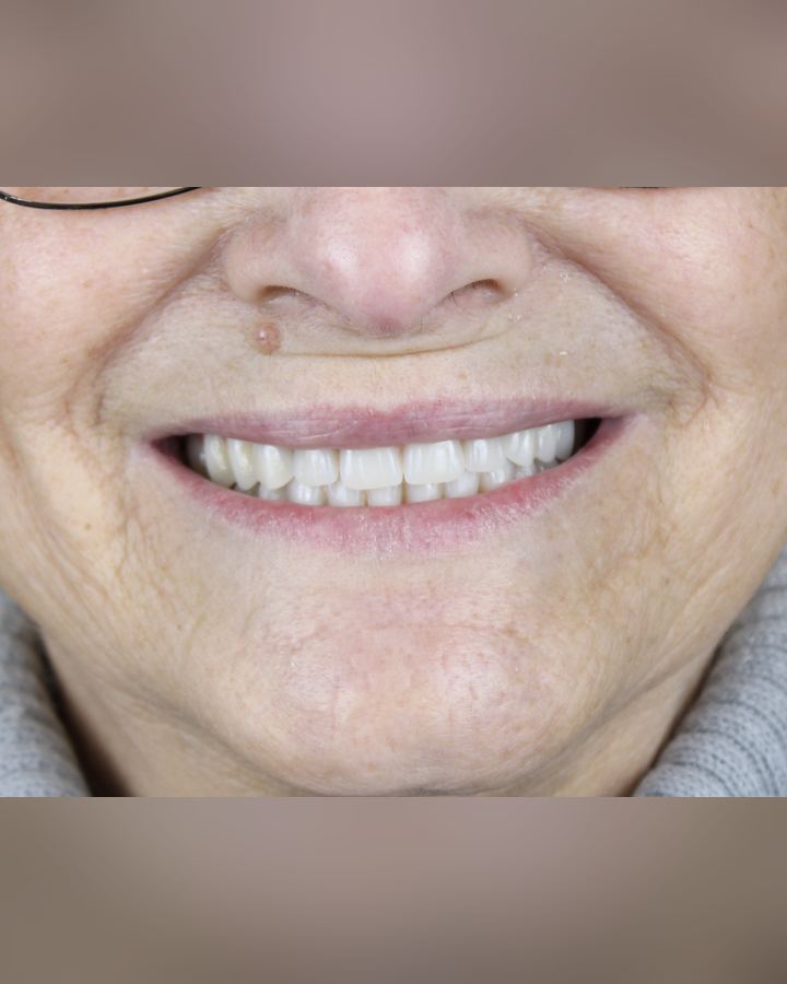 Resultado: Protocolo sobre implantes