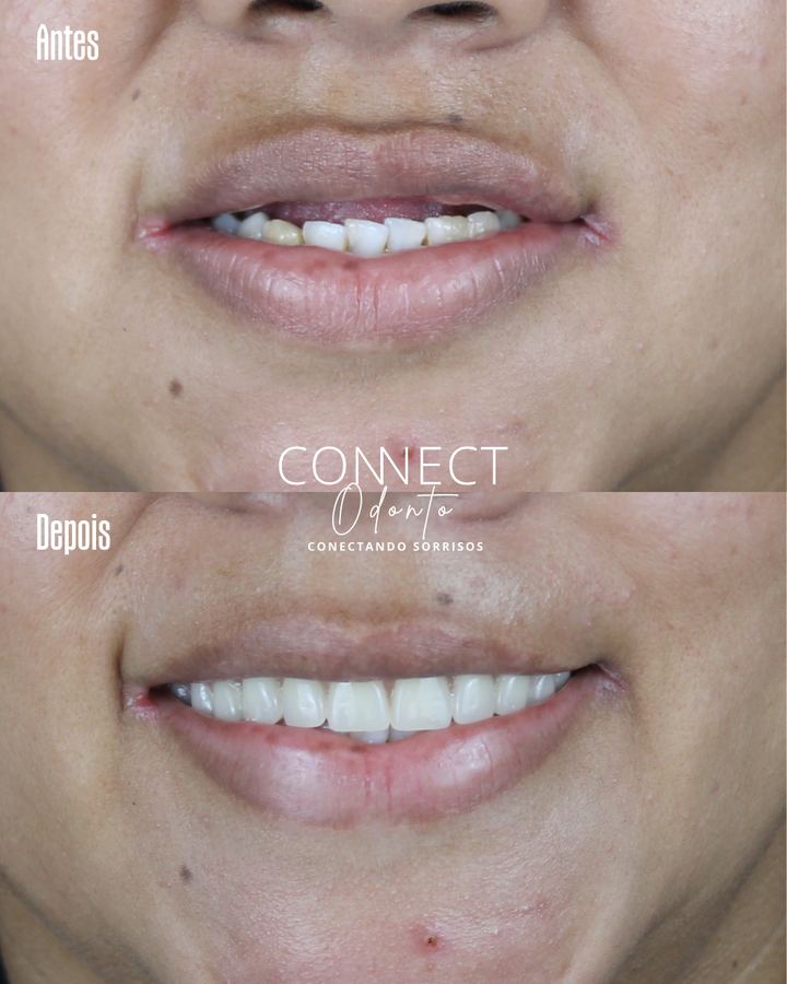 Antes e depois: Protocolo superior