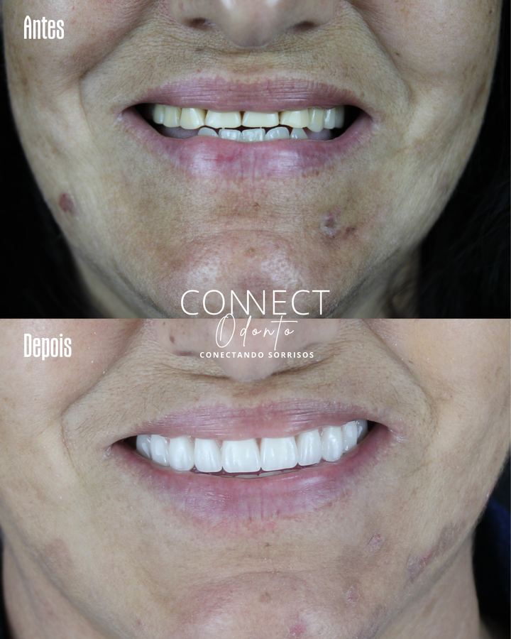 Antes e depois: Protocolo sobre implantes